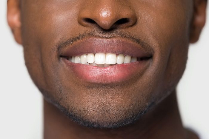 Why Choose Teeth Whitening Without Lasers