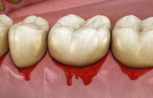 Gum Disease Heightens Risk of Cancer