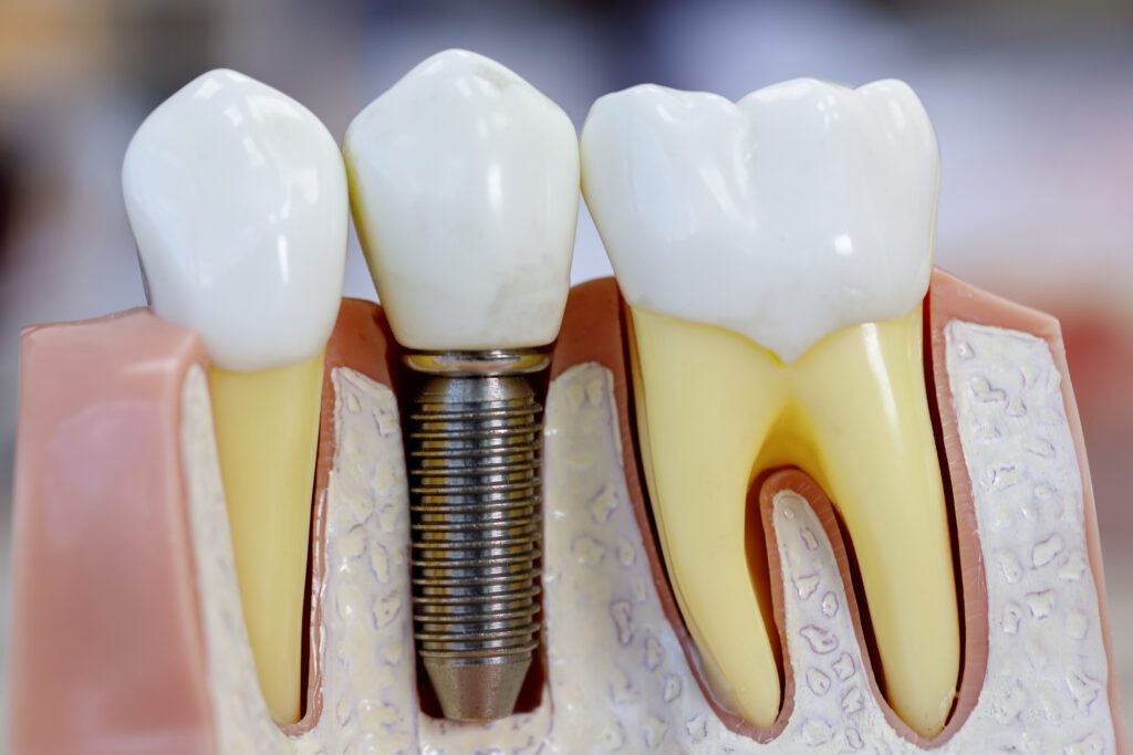 Cost of Dental Implants in Philadelphia PA