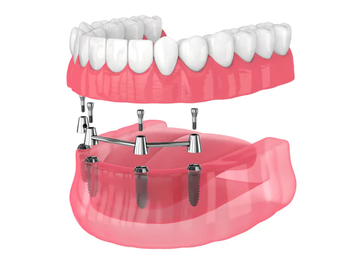 All-on-X Dental Implants