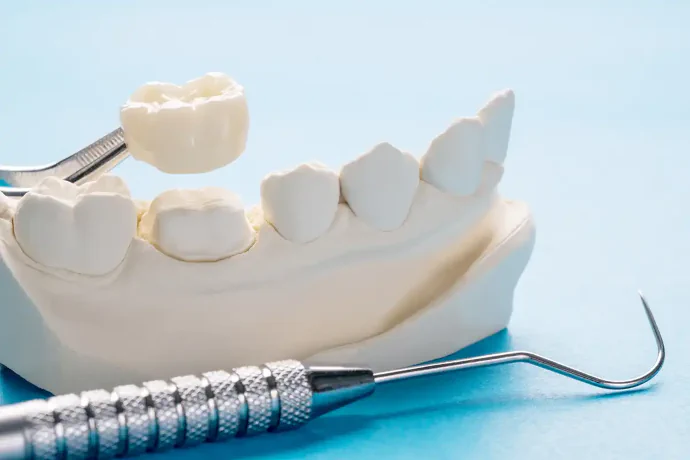 Crown Placement in Philadelphia, PA at Opus Dental Esthetics