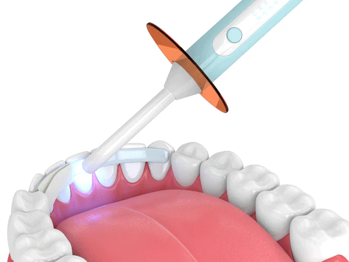 Dental Bonding in Philadelphia, PA at Opus Dental Esthetics