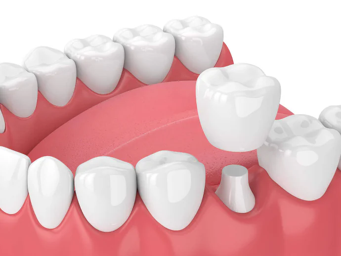 Dental Crowns in Philadelphia, PA at Opus Dental Esthetics