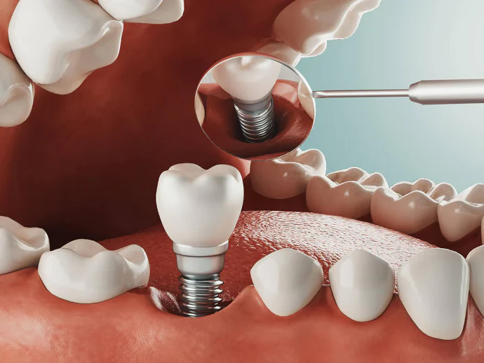 Dental Implants in Philadelphia, PA at Opus Dental Solutions