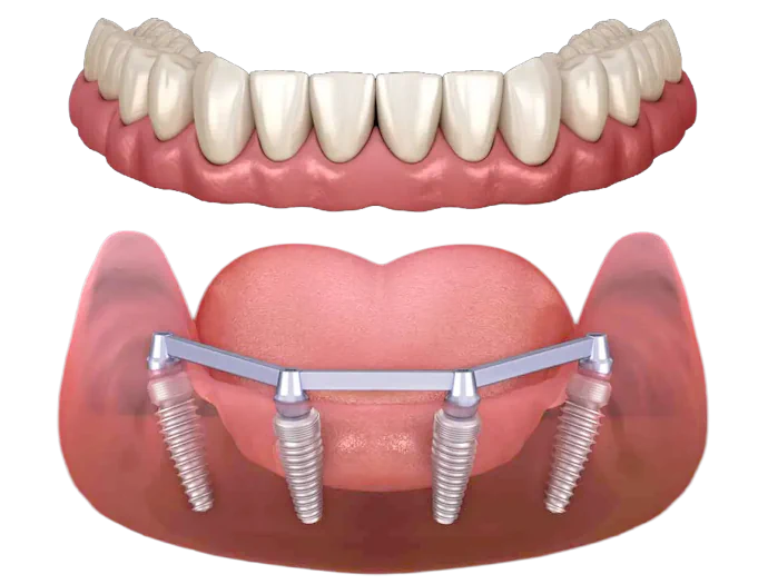Full-Mouth Reconstruction in Philadelphia, PA at Opus Dental Esthetics