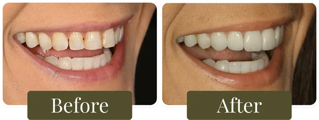 Smile Gallery at Opus Dental Esthetics