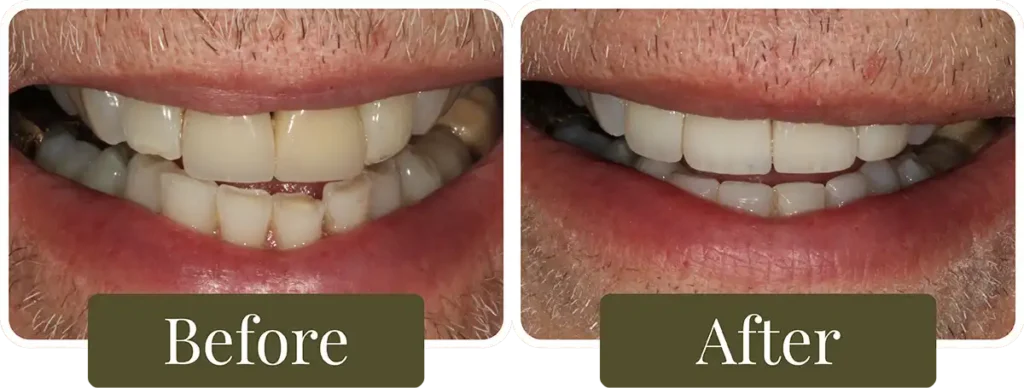 Before and after Smile Makeover at Opus Dental Esthetics