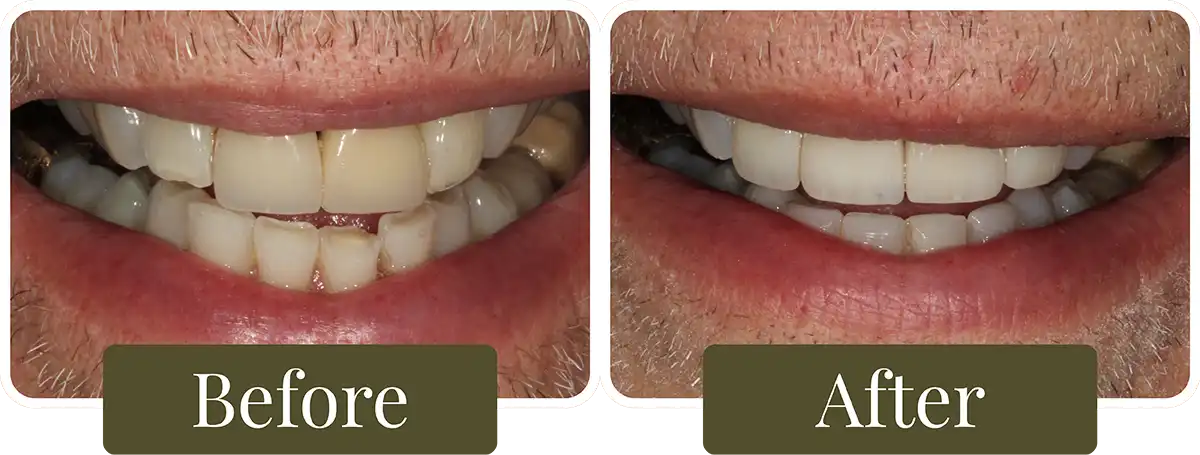 Before and after Smile Makeover at Opus Dental Esthetics