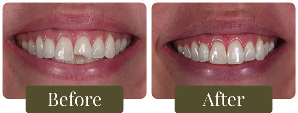 Before and after dental bonding at Opus Dental Esthetics