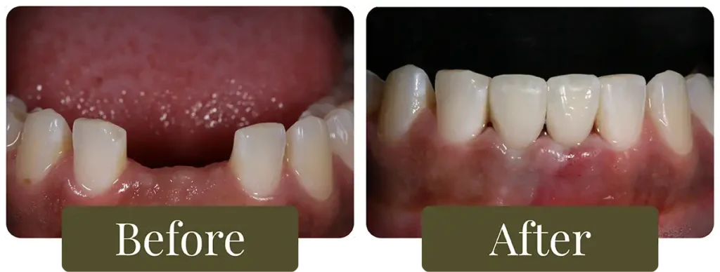 Before and after dental bridges at Opus Dental Esthetics