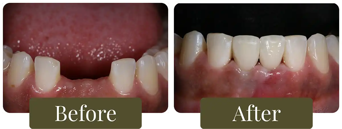 Before and after dental bridges at Opus Dental Esthetics