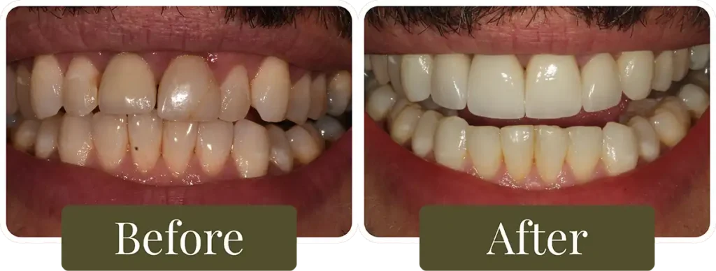 Before and after dental veneers in Philadelphia, PA