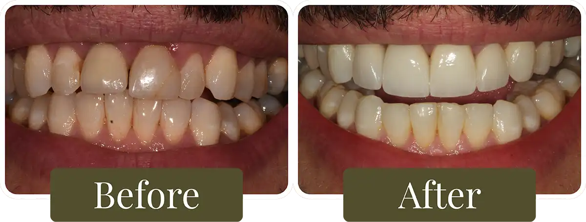 Before and after dental veneers in Philadelphia, PA
