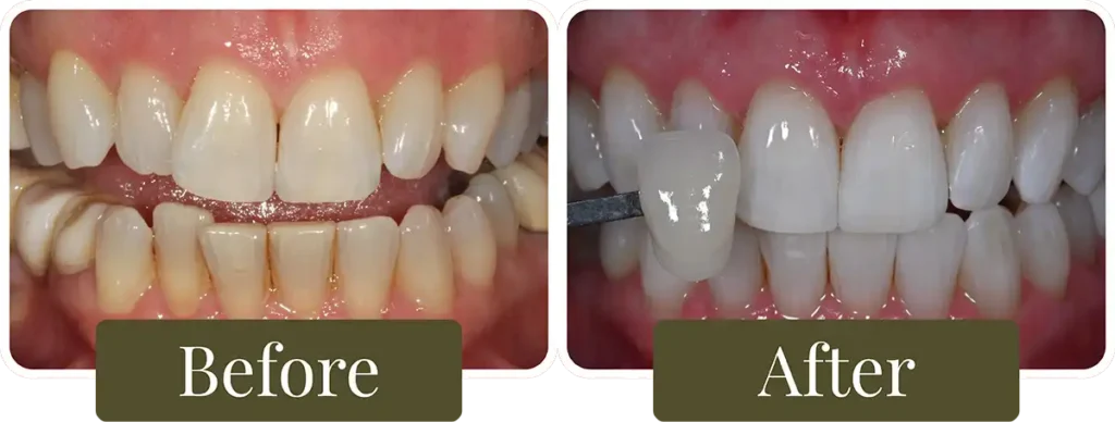 Before and after clear aligners at Opus Dental Esthetics
