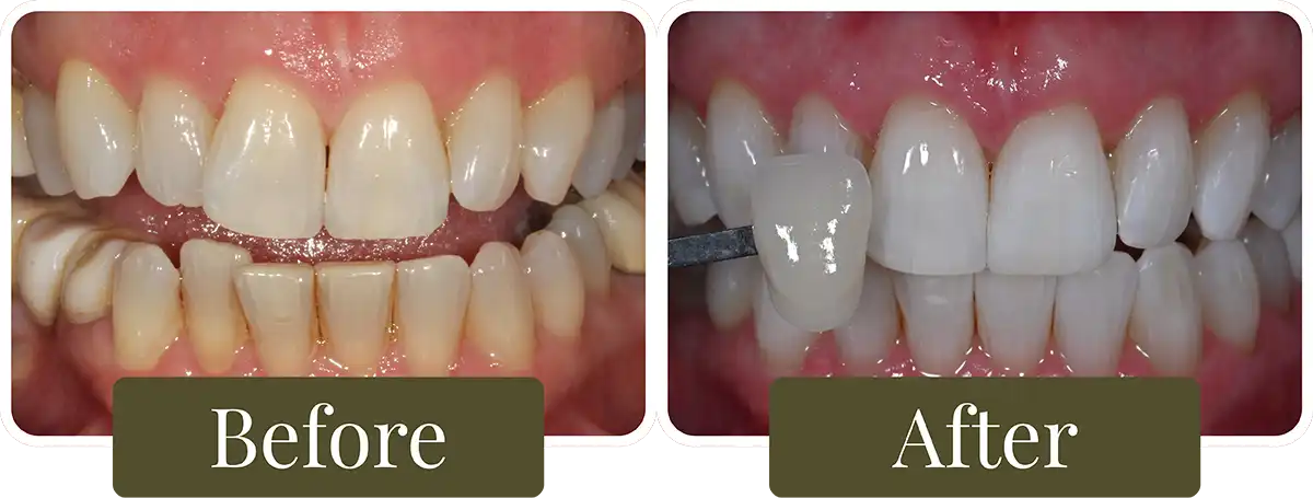 Before and after clear aligners at Opus Dental Esthetics