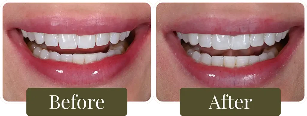 Before and after dental bonding at Opus Dental Esthetics