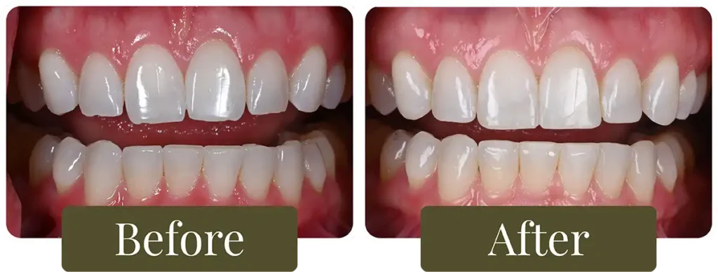 Before and after dental bonding at Opus Dental Esthetics