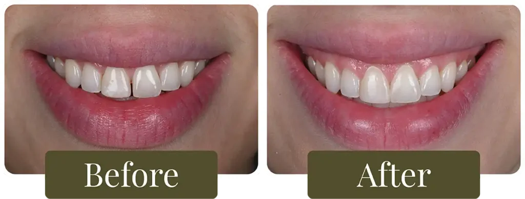 Before and after dental bonding at Opus Dental Esthetics