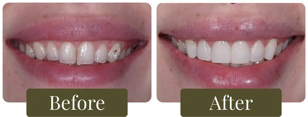 Before and after teeth whitening at Opus Dental Esthetics