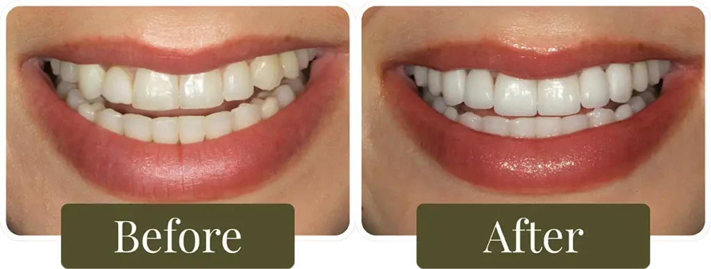 Before and after dental veneers at Opus Dental Esthetics