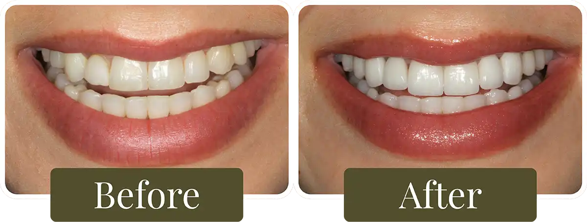 Before and after dental veneers at Opus Dental Esthetics