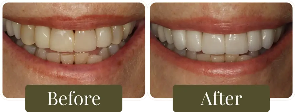 Before and after Smile Makeover at Opus Dental Esthetics
