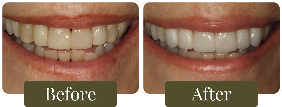 Before and after Smile Makeover at Opus Dental Esthetics