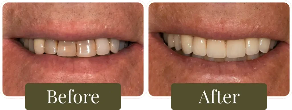 Before and after Smile Makeover at Opus Dental Esthetics