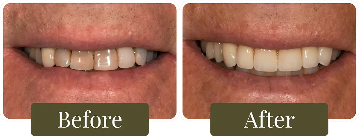 Before and after Smile Makeover at Opus Dental Esthetics