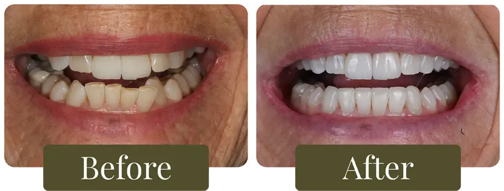 Before and after clear aligners at Opus Dental Esthetics