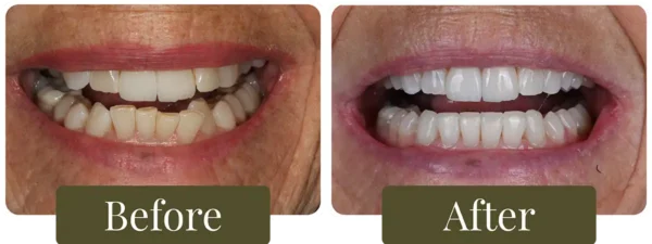 opus-smile-gallery-before-after24
