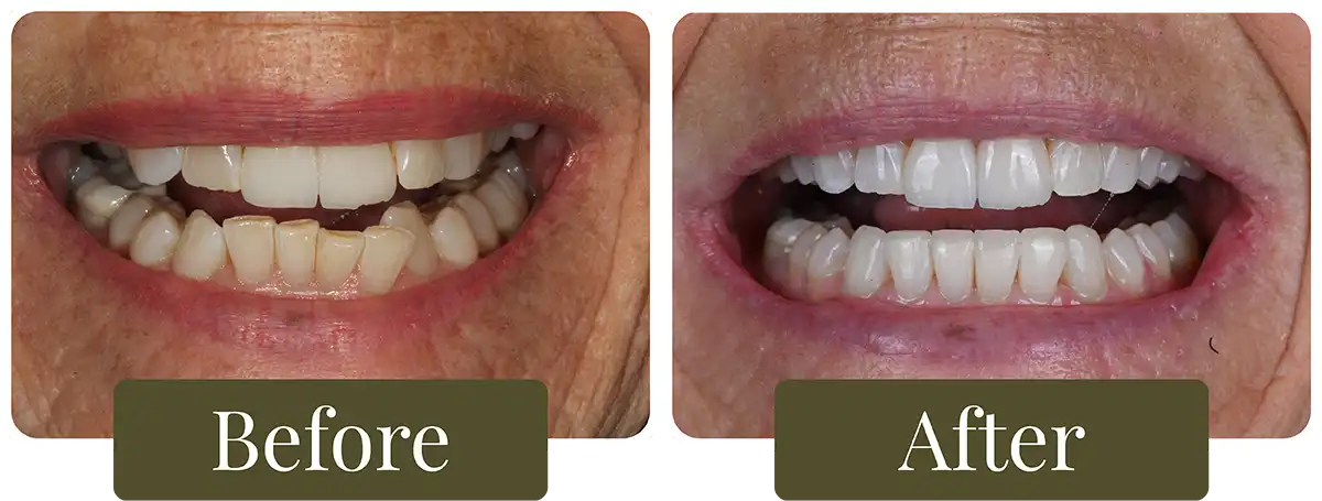Before and after clear aligners at Opus Dental Esthetics