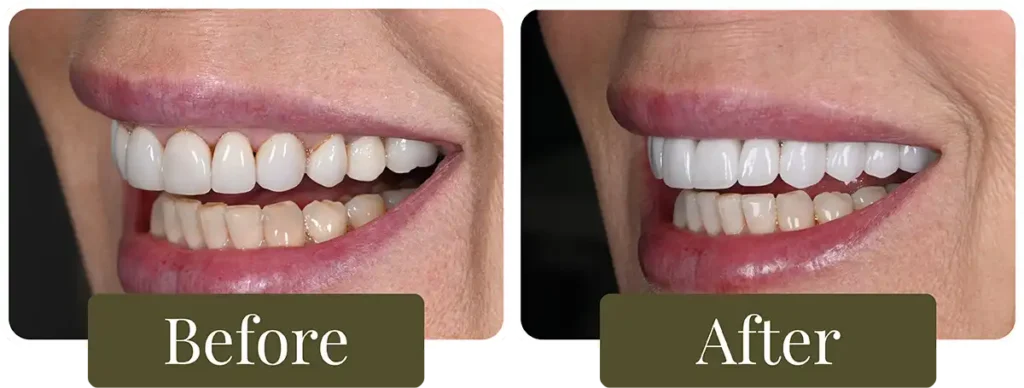 Before & After Cosmetic Dental Procedures