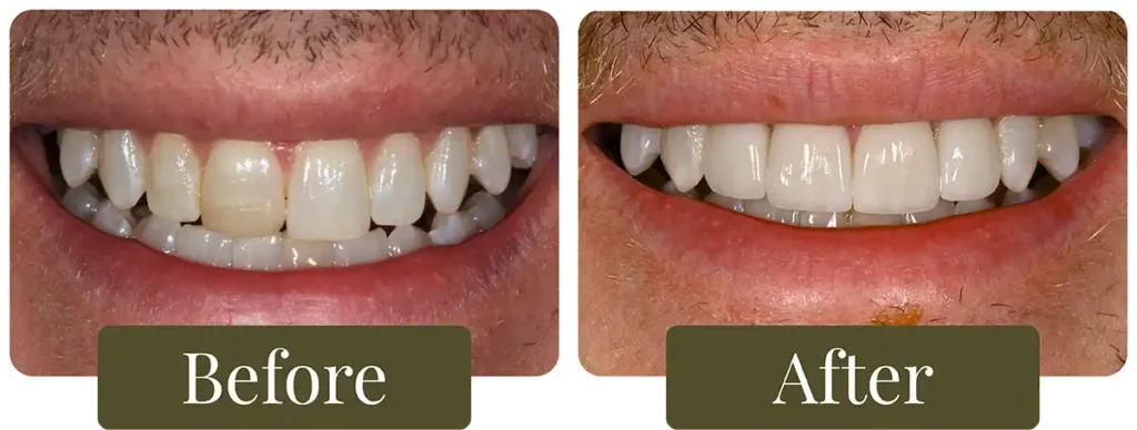 Before and after teeth whitening at Opus Dental Esthetics