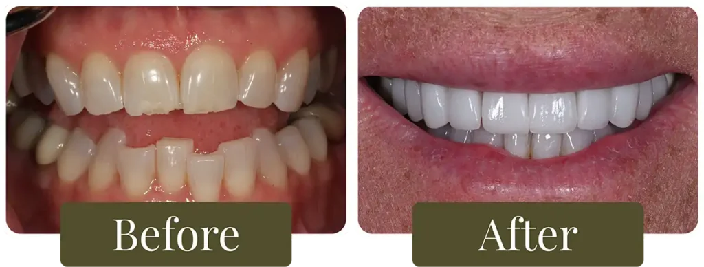 Before and after dental crowns at Opus Dental Esthetics