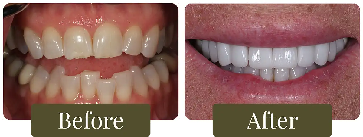Before and after dental crowns at Opus Dental Esthetics