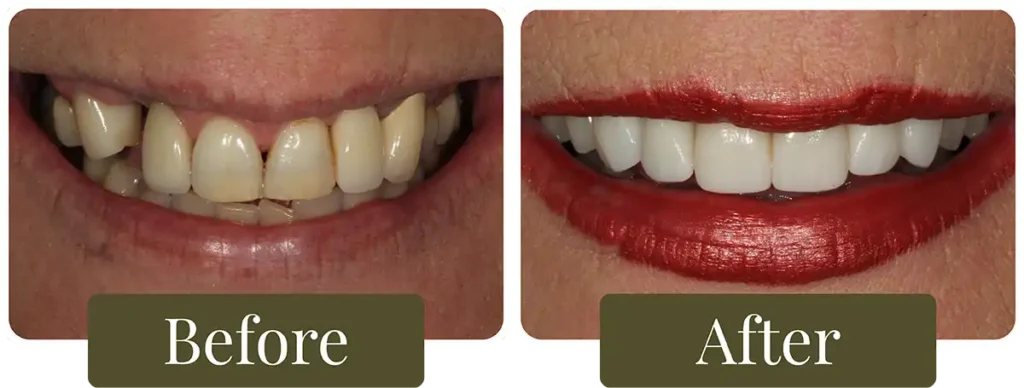 Before and after dental implants at Opus Dental Esthetics