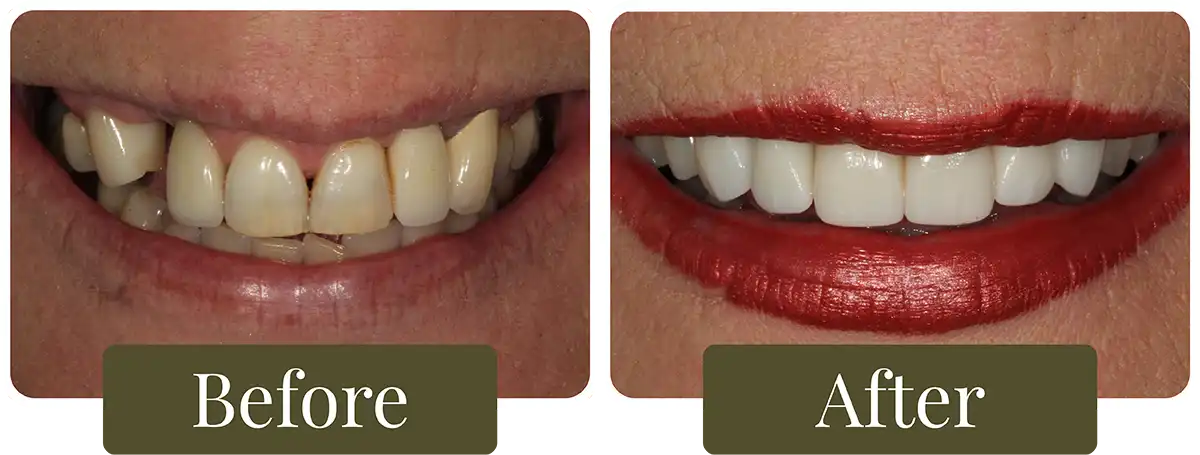 Before and after dental implants at Opus Dental Esthetics