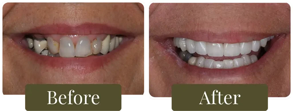 Before and after dental implants at Opus Dental Esthetics