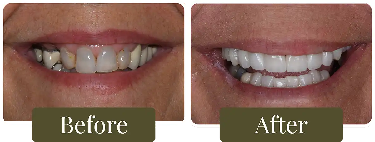 Before and after dental implants at Opus Dental Esthetics