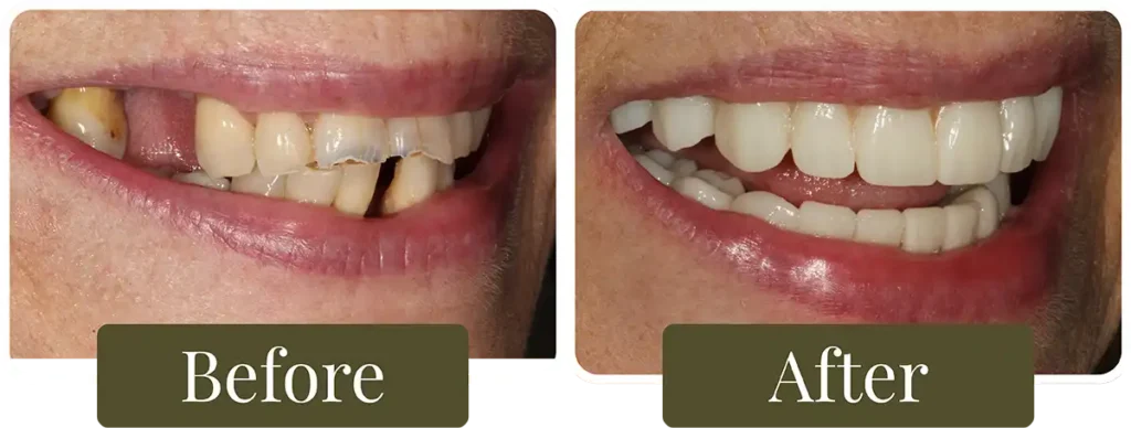 Before and after dental implants at Opus Dental Esthetics
