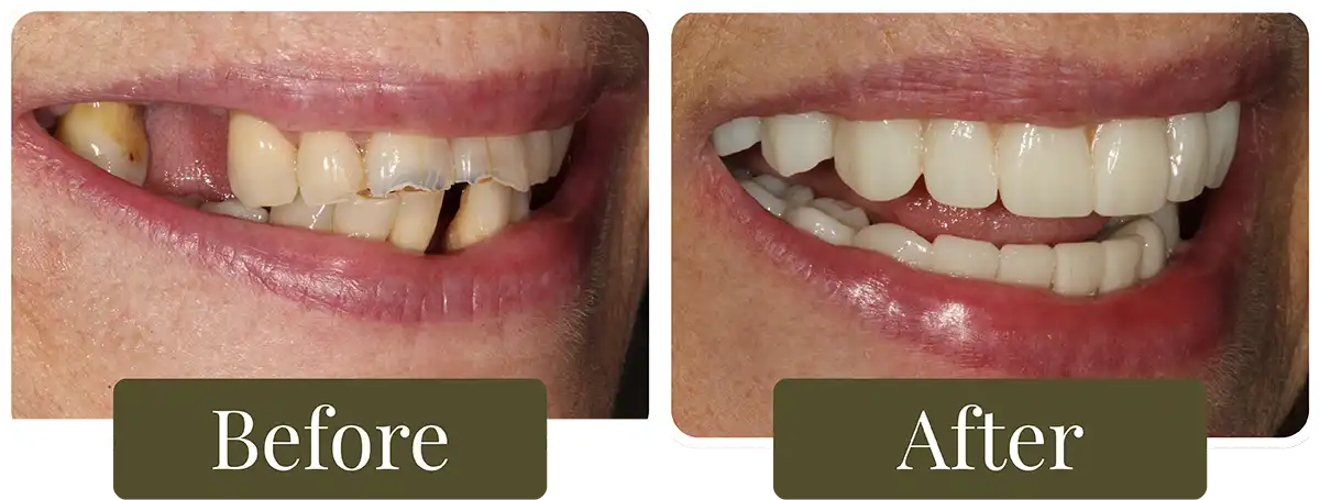 Before and after dental implants at Opus Dental Esthetics