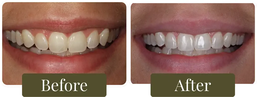 Before and after clear aligners at Opus Dental Esthetics