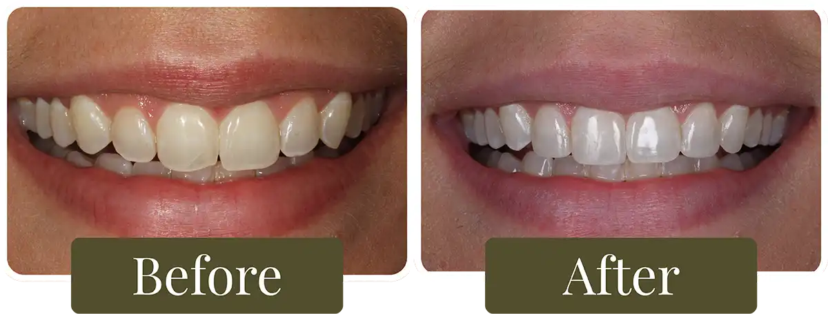 Before and after clear aligners at Opus Dental Esthetics