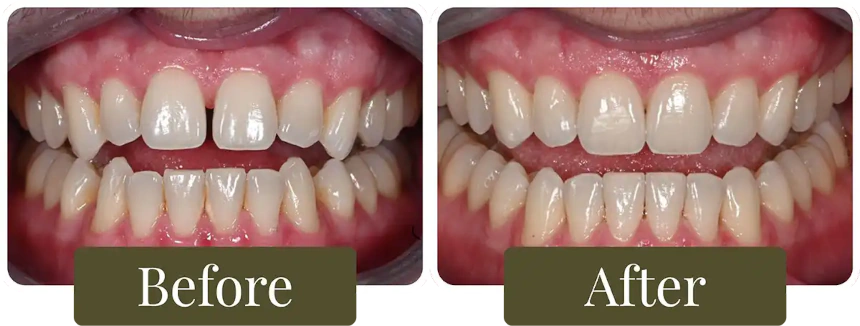 Before and after clear aligners in Philadelphia, PA at Opus Dental Esthetics