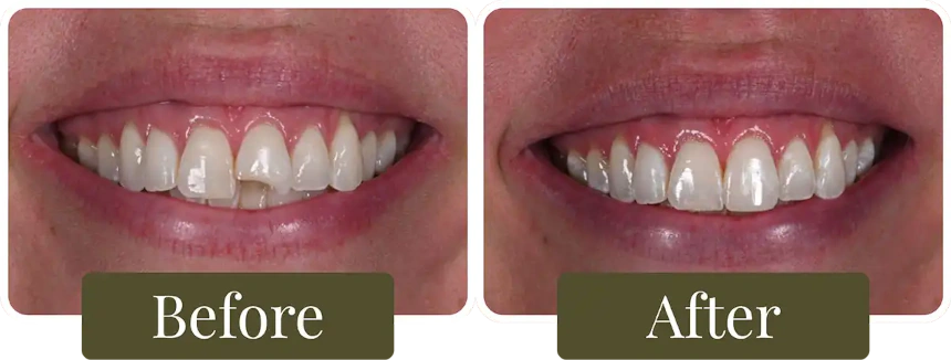 Before and after dental bonding in Philadelphia, PA at Opus Dental Esthetics