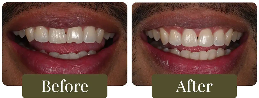 Before and after dental bonding in Philadelphia, PA at Opus Dental Esthetics