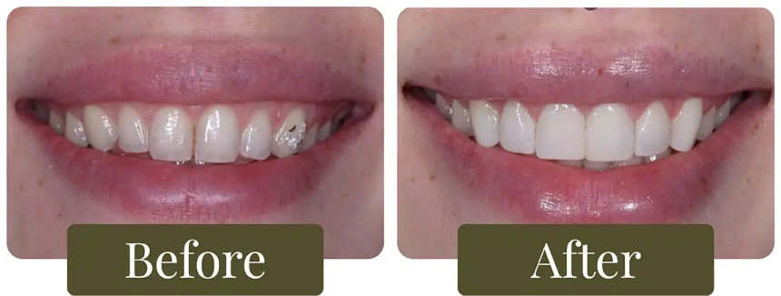 Before and after dental bonding in Philadelphia, PA at Opus Dental Esthetics
