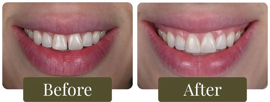 Before and after dental bonding in Philadelphia, PA at Opus Dental Esthetics