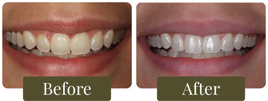 Before and after dental bonding in Philadelphia, PA at Opus Dental Esthetics